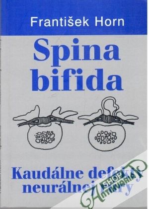 Obal knihy Spina bifida - kaudálne defekty neurálnej rúry