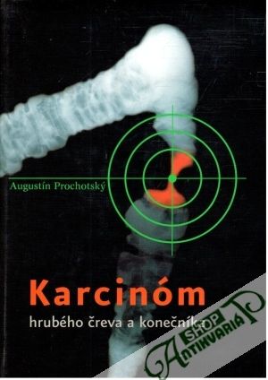 Karcinóm hrubého čreva a konečníka - Prochotský Augustín